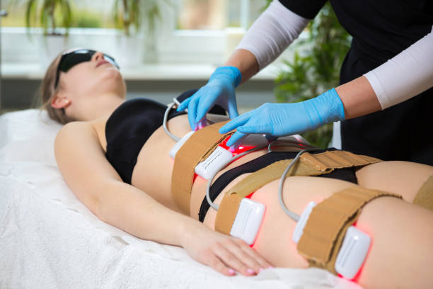 Laser Lipo